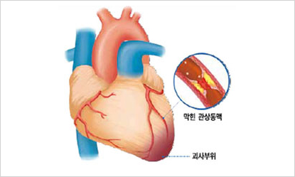 심근경색 괴사 이미지