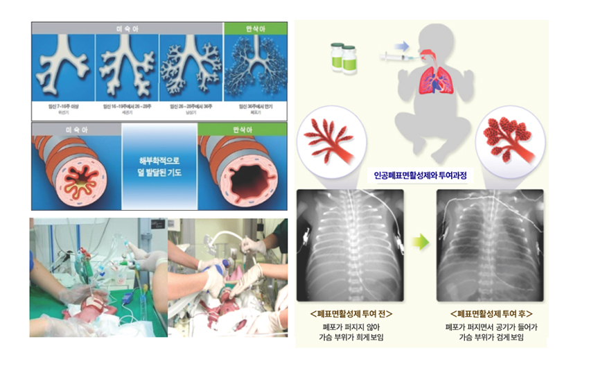 호흡곤란 증후군