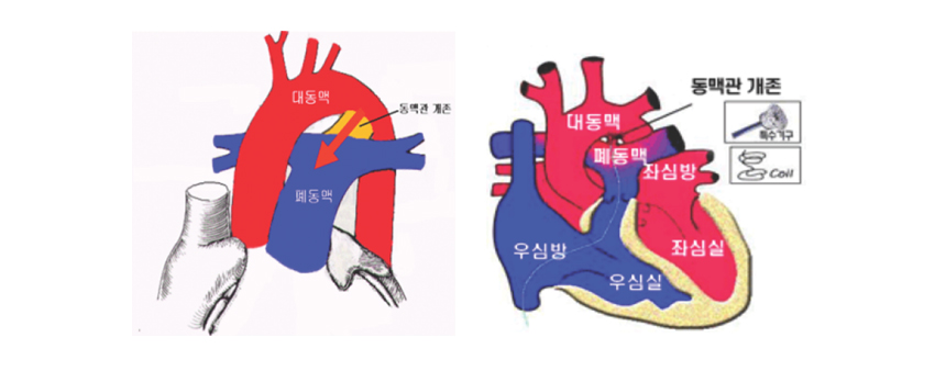 동맥관개존중