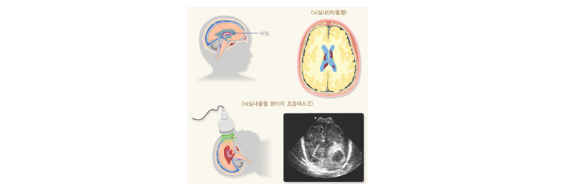 뇌출혈/뇌실 내 출혈
