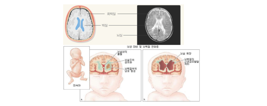 뇌실주위 백질 연화증