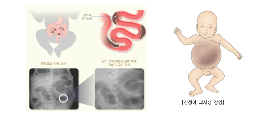 괴사성 장염