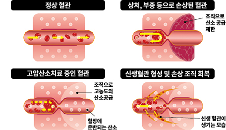 고압산소치료